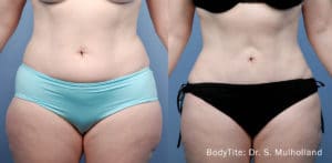 sm bodytite 1a abdomen 24wks copy 1 300x147 1