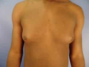 GYNECOMASTIA / POST OP DAY 1