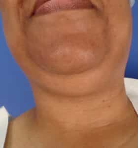 Liposuction of Chin and Neck