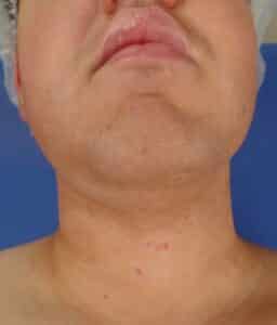 Liposuction and FaceTite of the chin